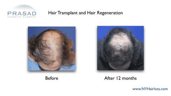 best way to stop hair loss and regrow hair
